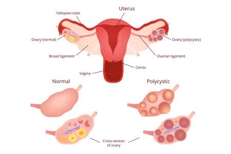 What is PCOD or PCOS