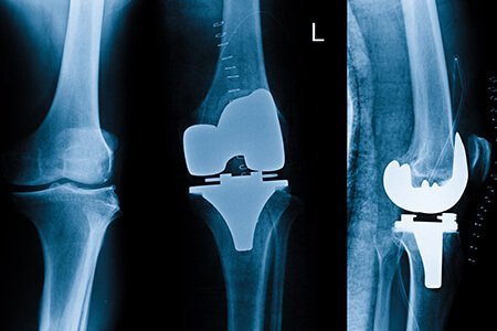 xray knee replacement