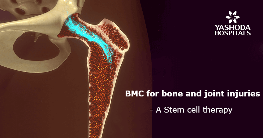 Bone Marrow Concentrate (BMAC)
