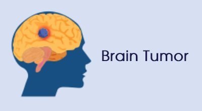 Brain Tumor Infographics