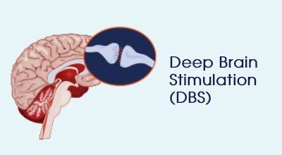 Deep brain stimulation (DBS) Infographics