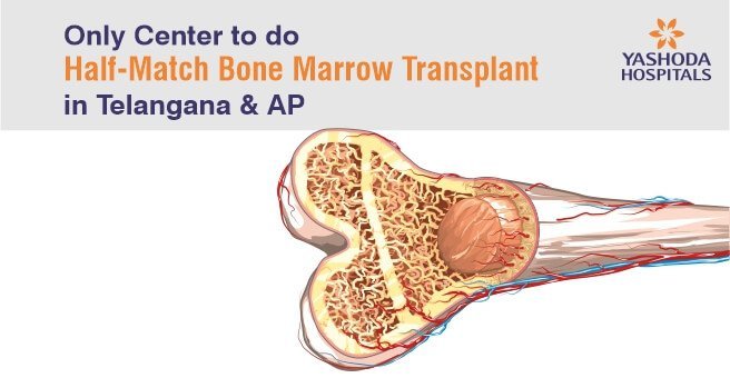 First ever half-matched bone-marrow transplantation