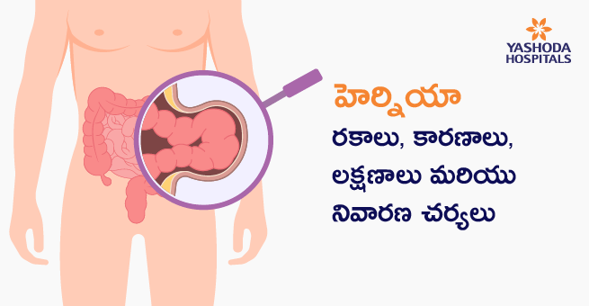 Hernia Types, Causes, Symptoms, Prevention Methods (Telugu) banner