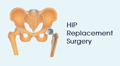 Hip replacement surgery Infographics