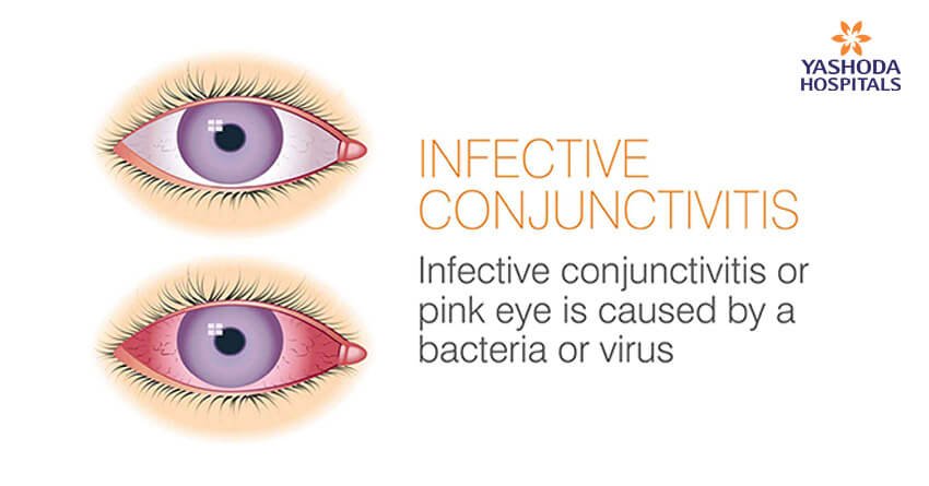 Infective Conjunctivitis eye problem