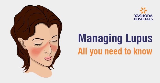 Managing Lupus:All you need to know