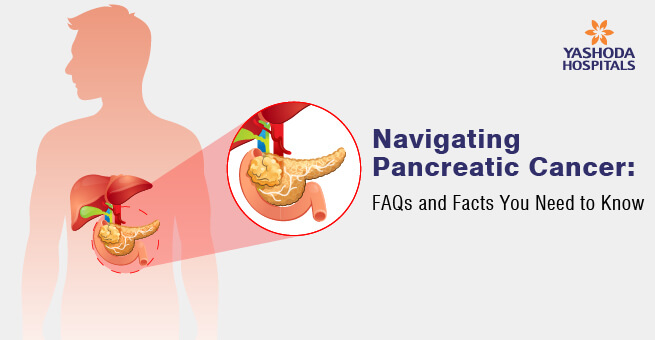 Navigating Pancreatic Cancer: FAQs and Facts You Need to Know
