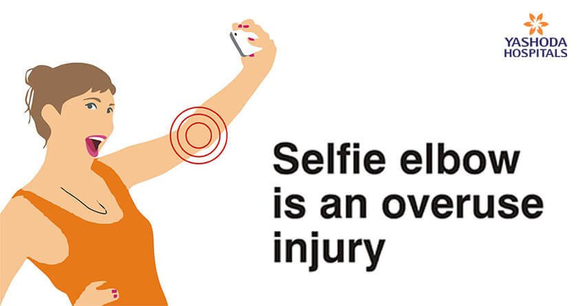 Selfie elbow is an overuse injury; only conscious efforts to take pressure off the elbow may be of help