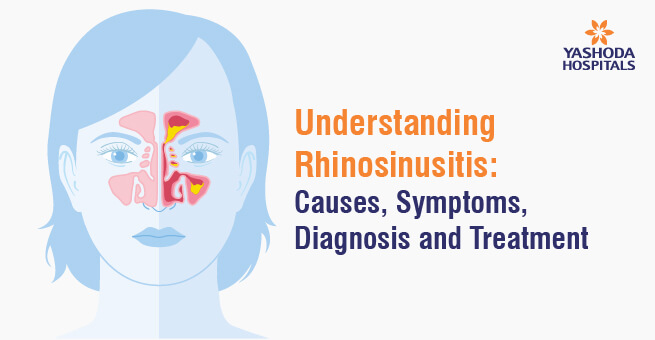 Understanding Rhinosinusitis banner