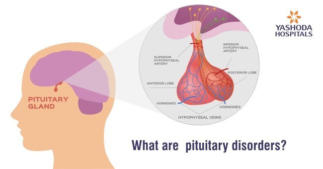 What are pituitary disorders