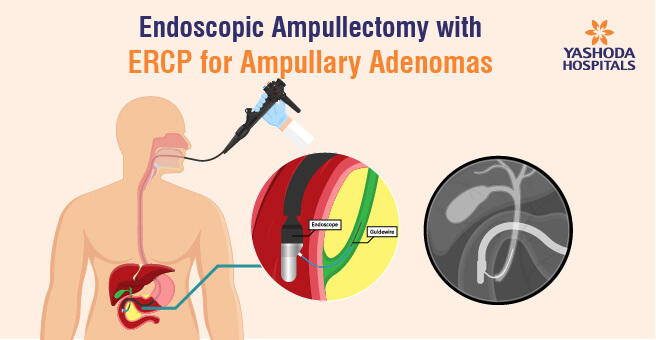 endoscopic-ampullectomy-banner