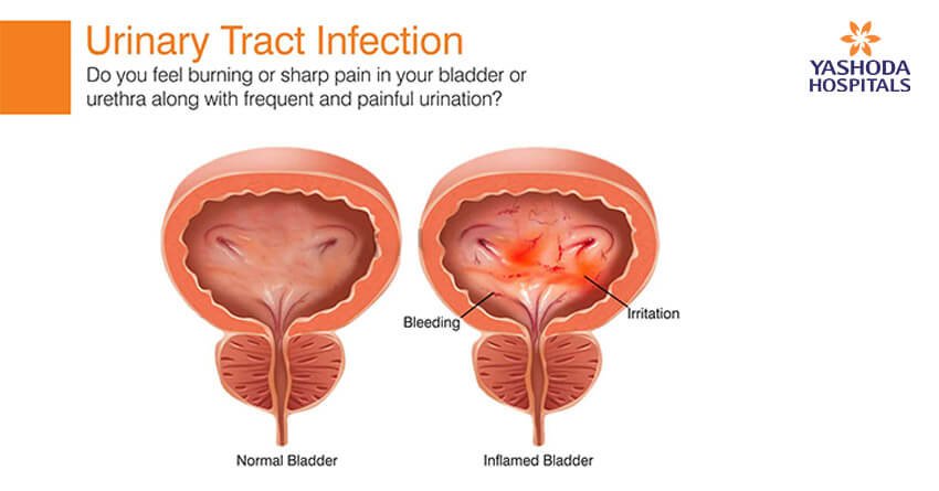 urinery tract infection